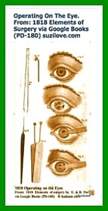 1818 Instruments For Operating On The Eye. 1818 Elements of Surgery By John Syng Dorsey. via Google Books (PD-150)