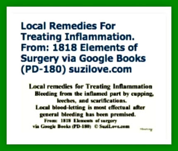 1818 Local remedies For Treating Inflammation. 1818 Elements of Surgery By John Syng Dorsey. via Google Books (PD-150)