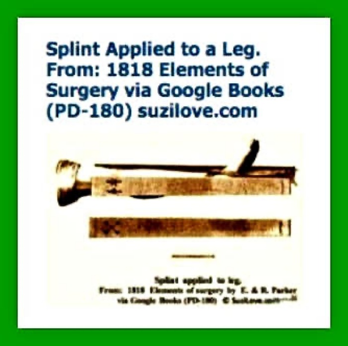 1818 Splint Applied To A Leg. 1818 Elements of Surgery By John Syng Dorsey. via Google Books (PD-150)