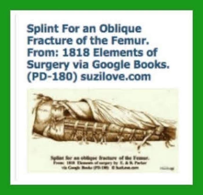 1818 Splint For an Oblique Fracture of the Femur. 1818 Elements of Surgery By John Syng Dorsey. via Google Books (PD-150)
