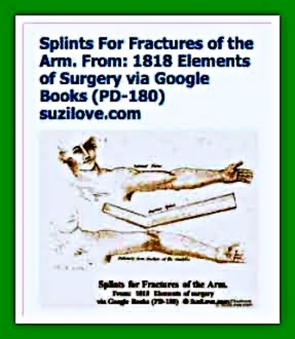 1818 Splints For Fractures of the Arm. 1818 Elements of Surgery By John Syng Dorsey. via Google Books (PD-150)