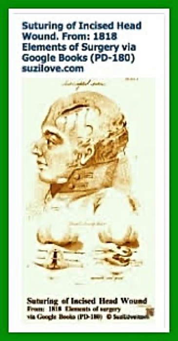 1818 Suturing Of Incised Head Wound. 1818 Elements of Surgery By John Syng Dorsey. via Google Books (PD-150)