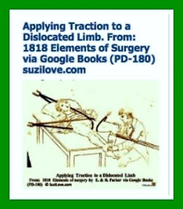 1818 Applying Traction to a Dislocated Limb.1818 Elements of Surgery By John Syng Dorsey. via Google Books (PD-150)